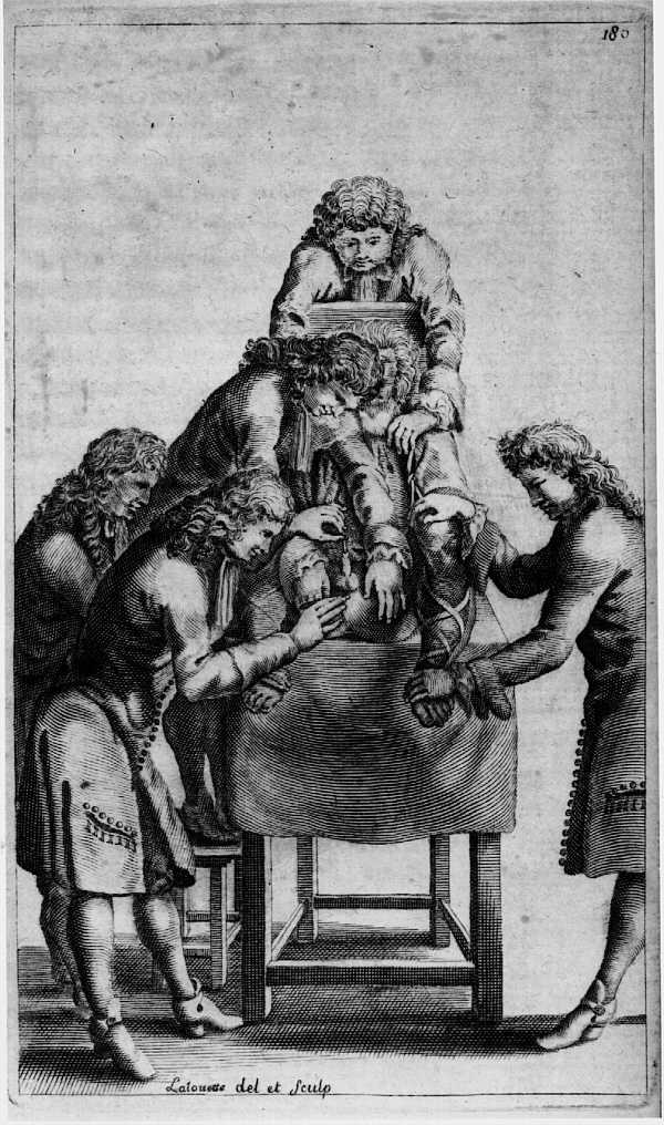 Marin Marais opération de la taille